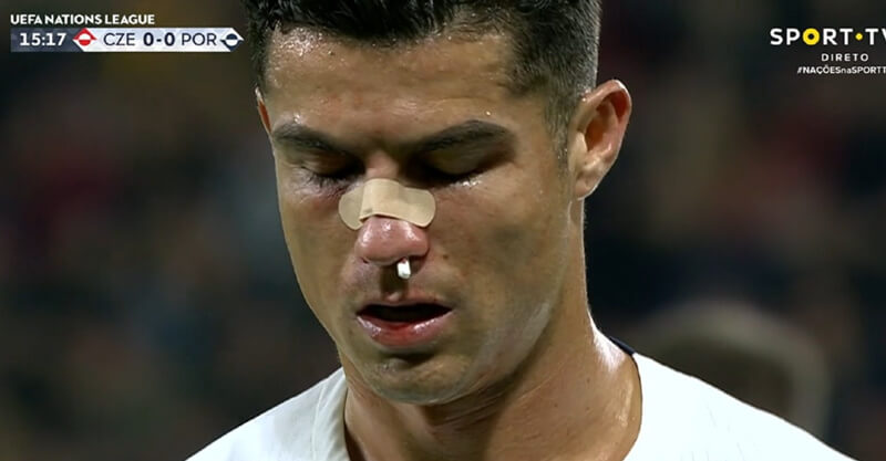 Cristiano Ronaldo a sangrar no República Checa-Portugal