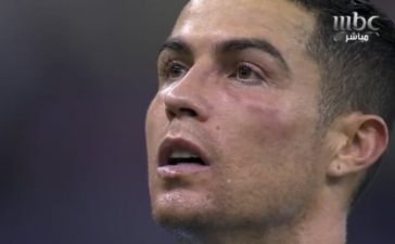 Cristiano Ronaldo com a cara inchada após o jogo entre as estrelas da liga saudita e o PSG