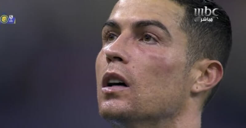 Cristiano Ronaldo com a cara inchada após o jogo entre as estrelas da liga saudita e o PSG